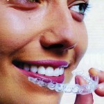 Quels appareils dentaires adulte existent pour replacer ses dents ?