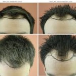 A quel moment faire une greffe de cheveux ?