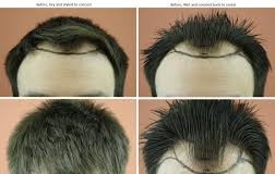 A quel moment faire une greffe de cheveux ?